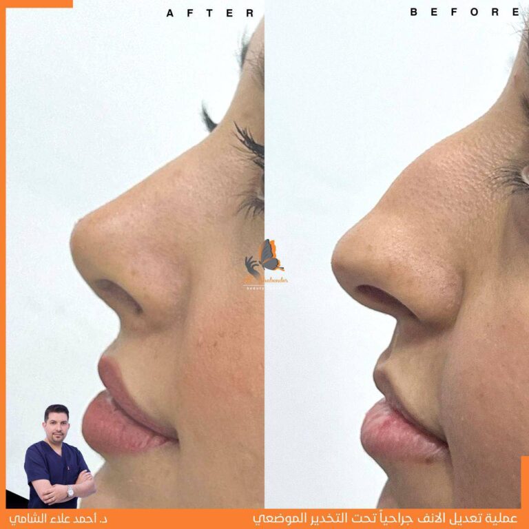 تجميل الانف 768x768