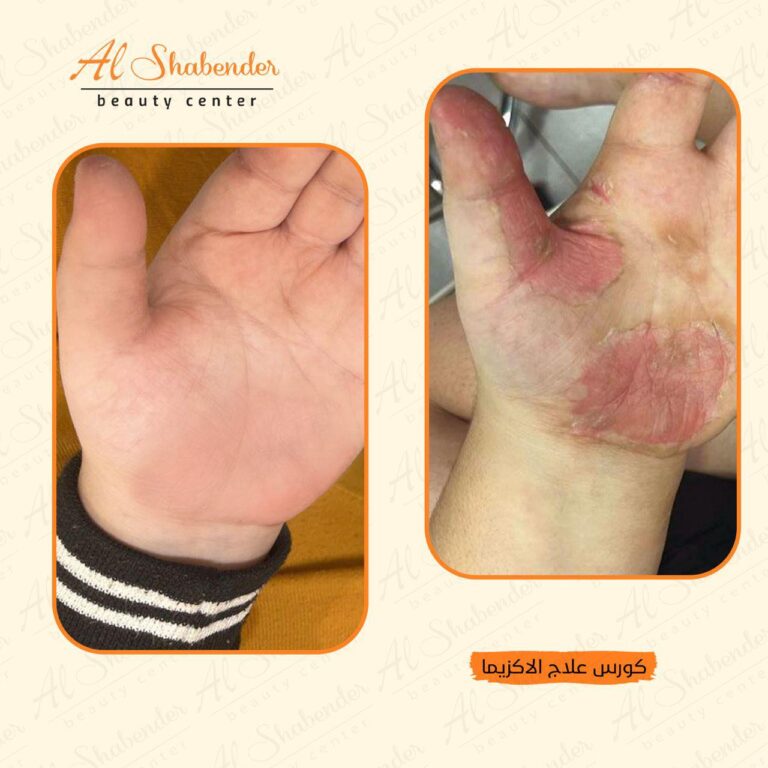 علاج الاكزما 768x768