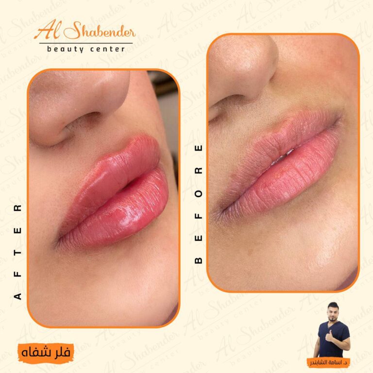 فلر شفاه 768x768