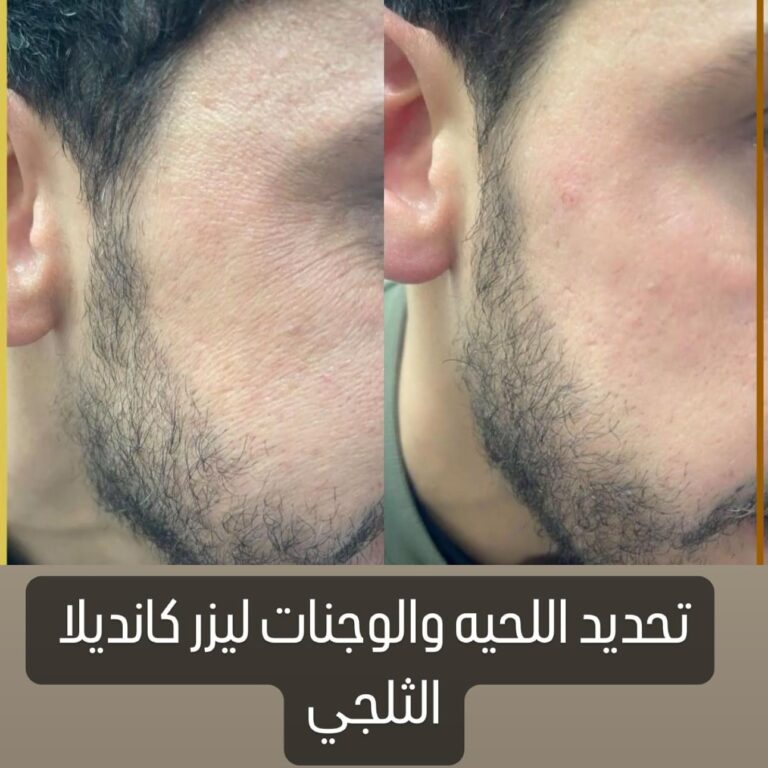 JPG ازله شعر الذقن 768x768