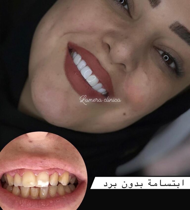 JPG تنضيف الاسنان 768x850