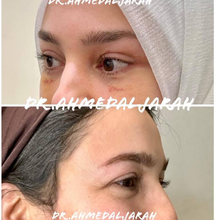 jpg قص الاجفان 768x768