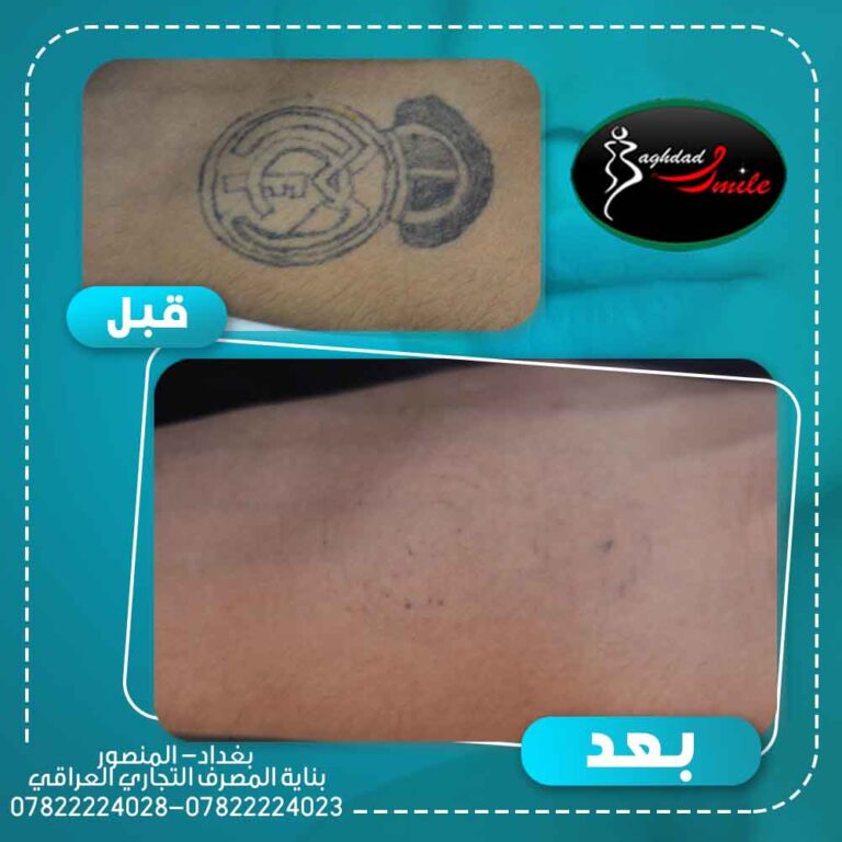 إزالة الوشم بالليزر 768x768