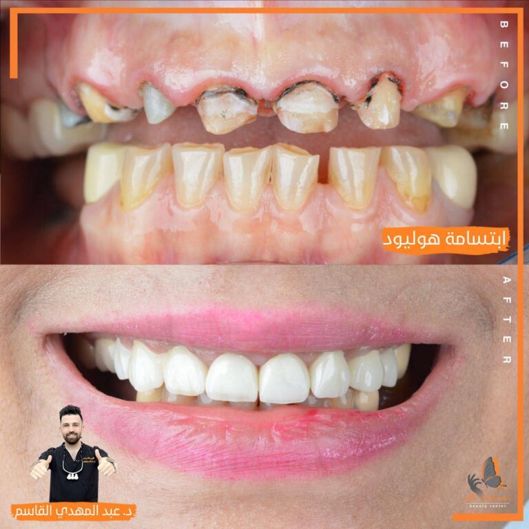 ابتسامه هوليود 1 768x768