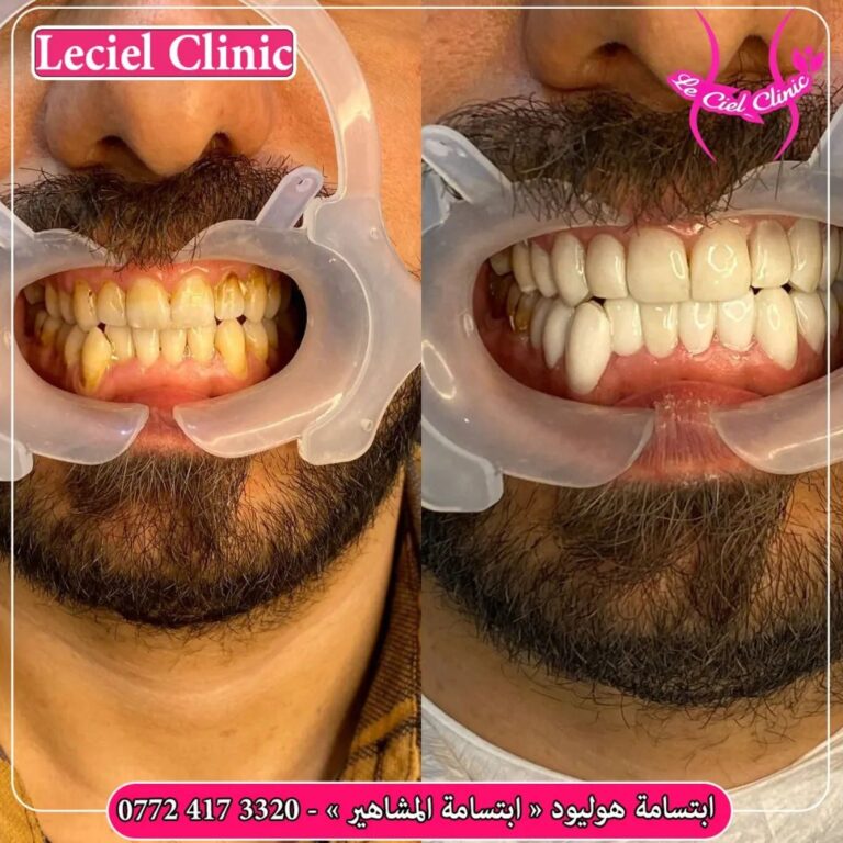 ابتسامه هوليود 2 768x768