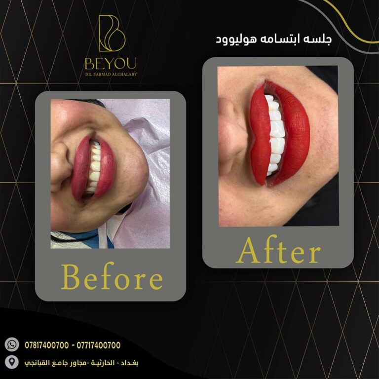 ابتسامه هوليوود 768x768