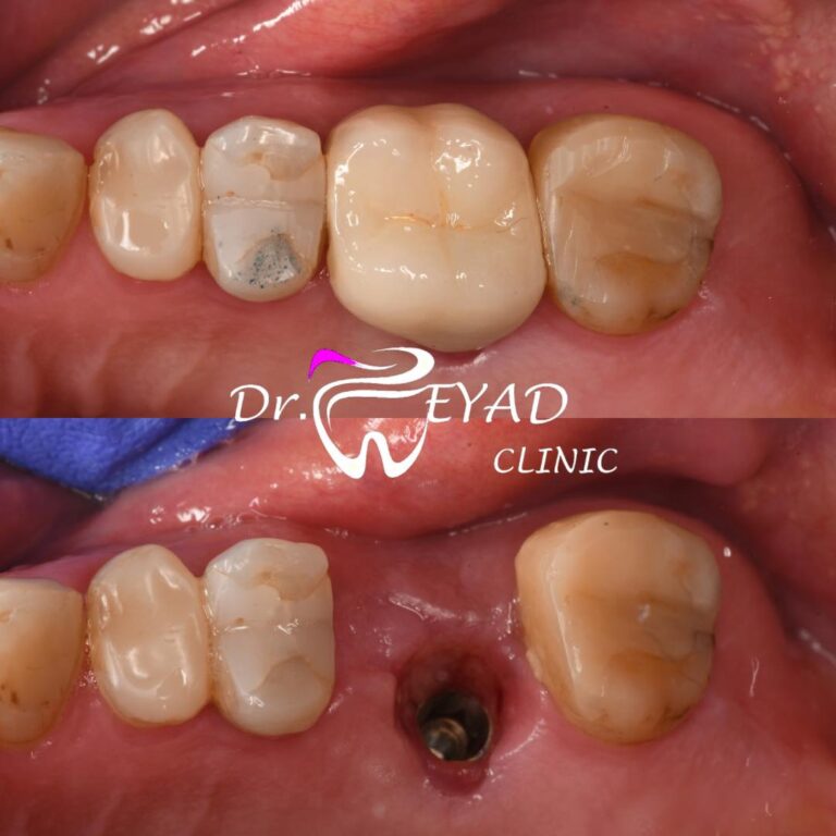اثناء زراعه الاسنان 768x768