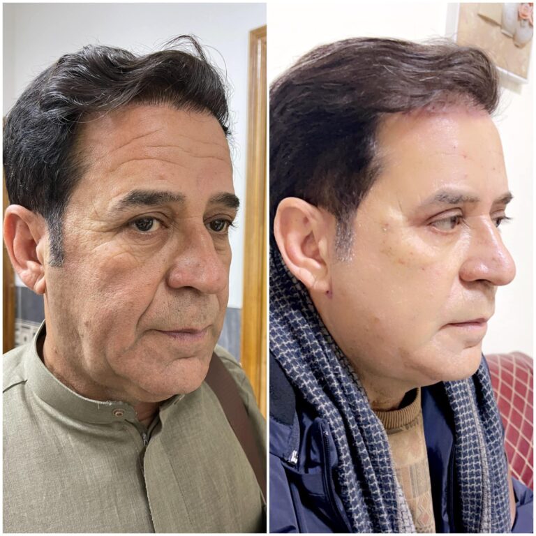 اخفاء التجاعيد من الوجه 768x768