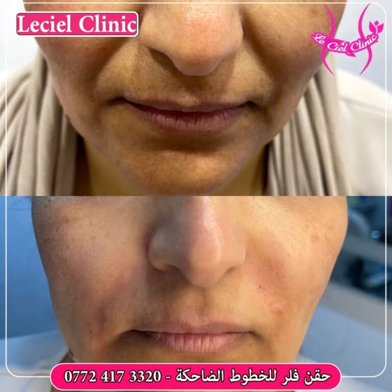 اخفاء الخطوط الضاحكه 768x768