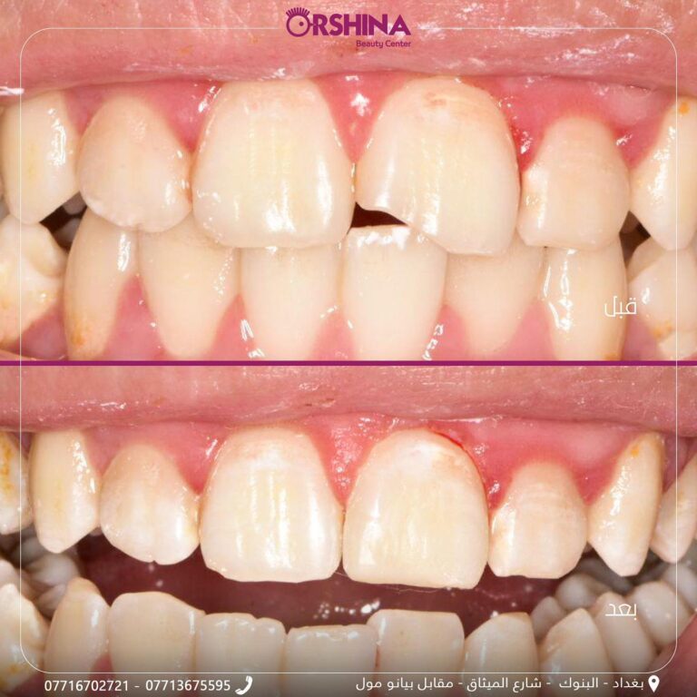 ارجاع الاسنان الى طبيعتها 768x768