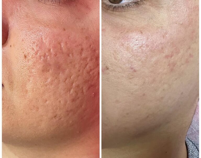 ازالة اثار حب الشاب 768x604