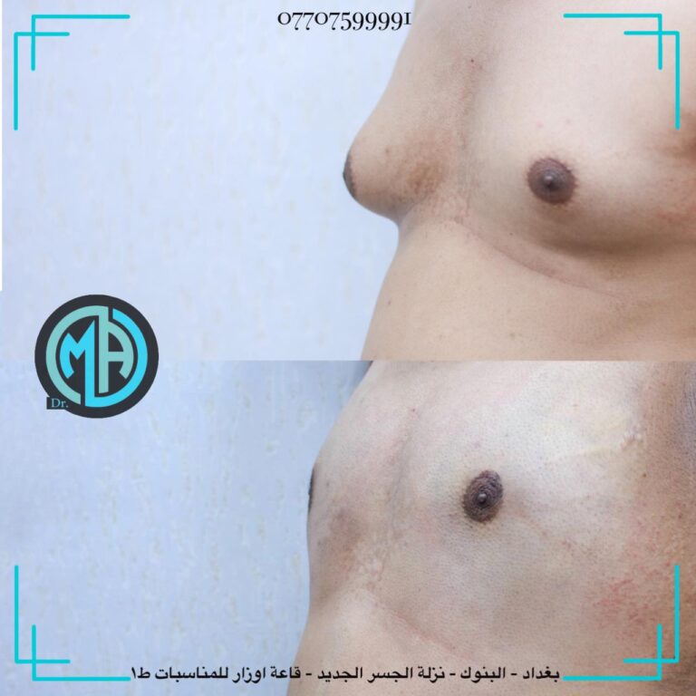 ازالة التثدي 768x768