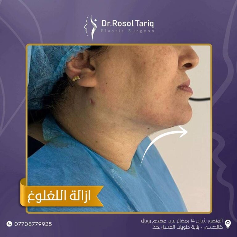 ازالة الذقن المزدوج 768x768