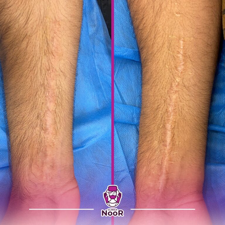 ازالة الندب و الاثار 768x768