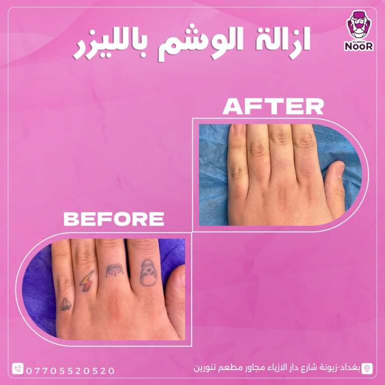 ازالة الوشم 768x768