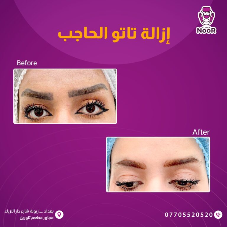 ازالة تاتو 768x768