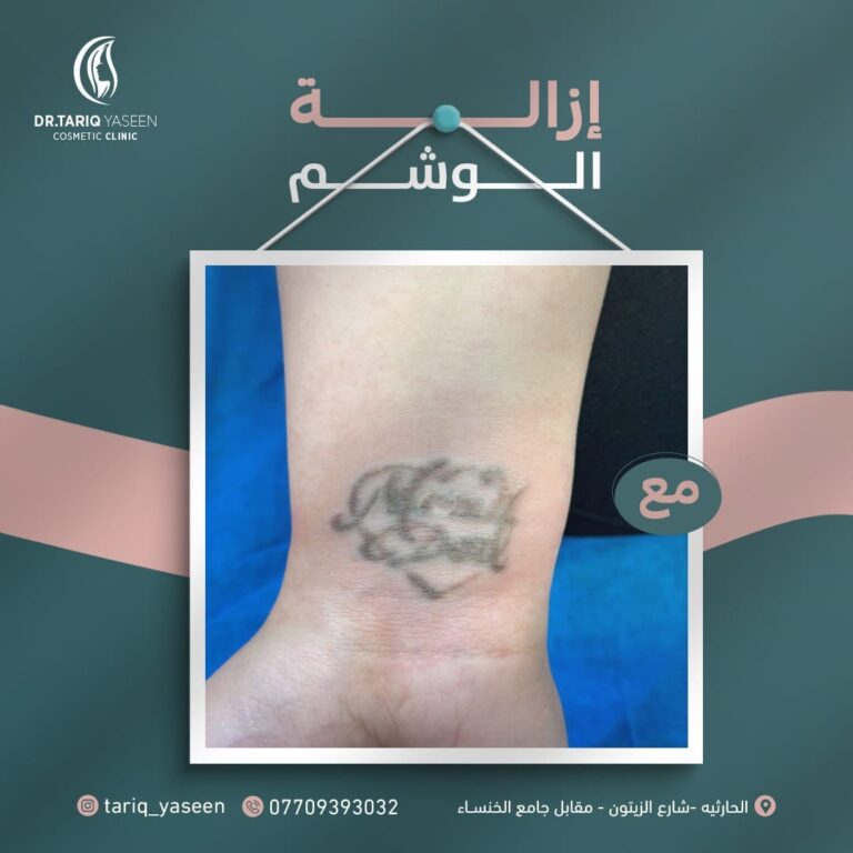 ازالة وشم 1 768x768