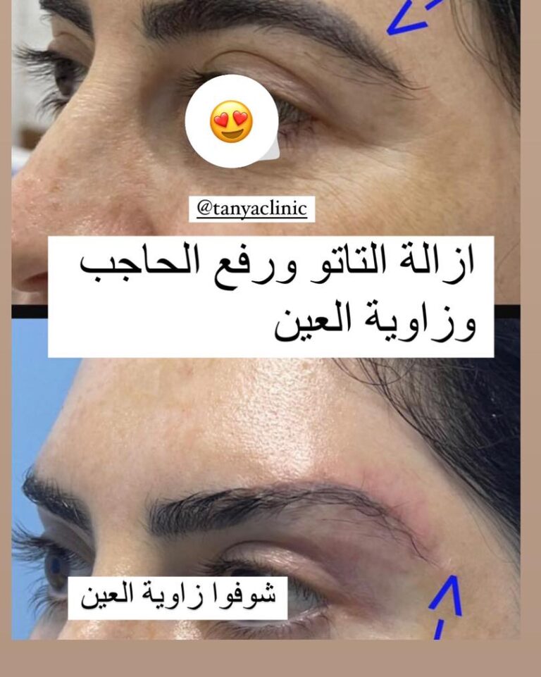 ازاله التاتو ورفع الحاجب وزاويه العين 768x961