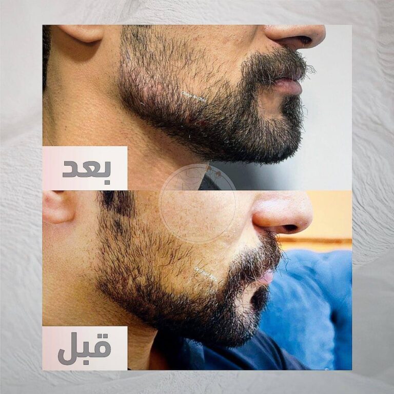 ازاله الشعر 768x768