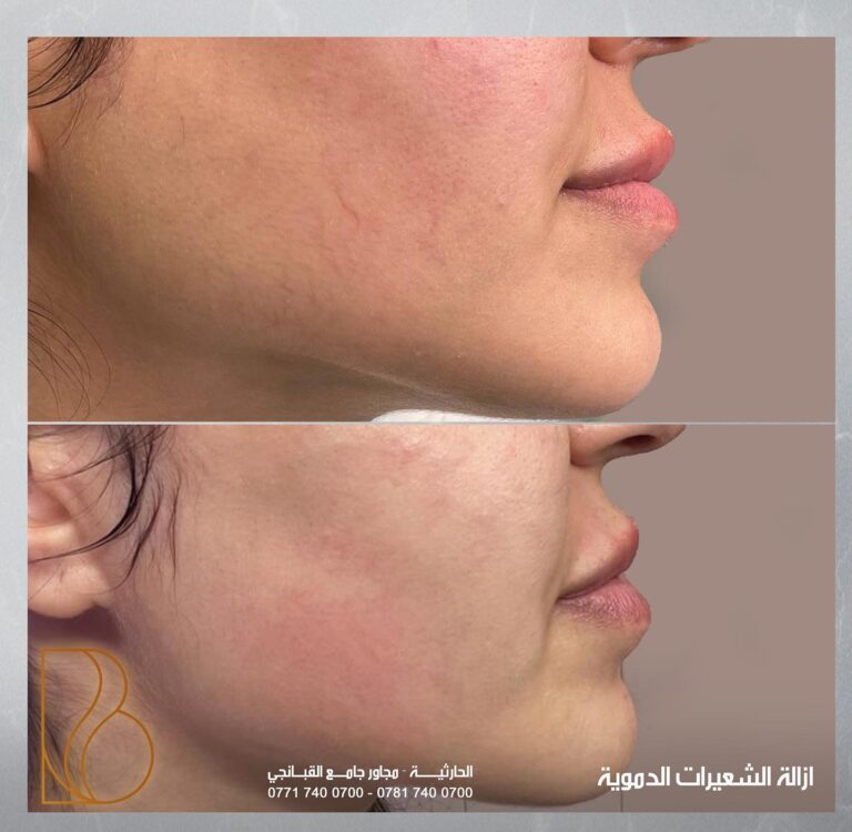 ازاله الشعيرات الدمويه 768x750