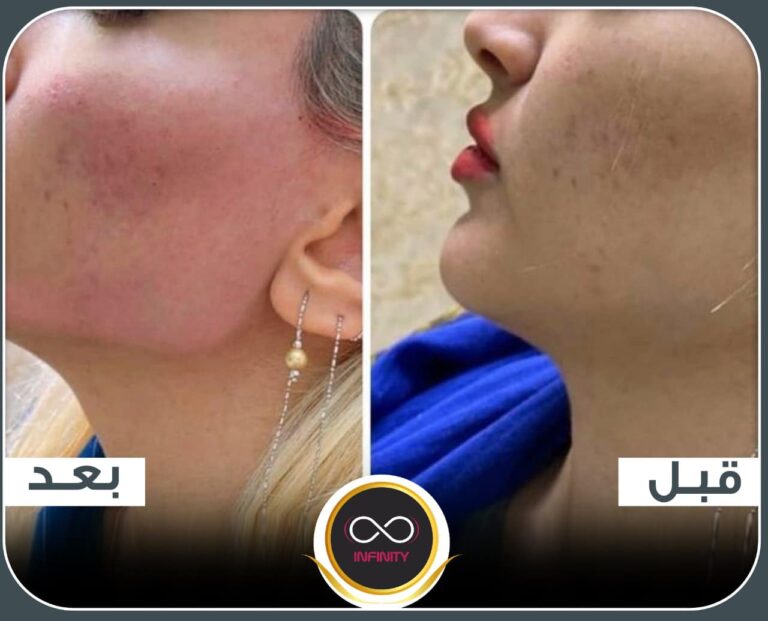 ازلة الشعر 768x621