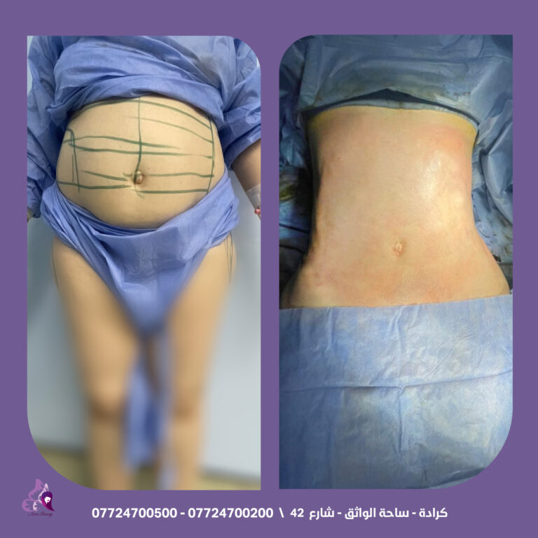 ازلة شحوم البط 768x768