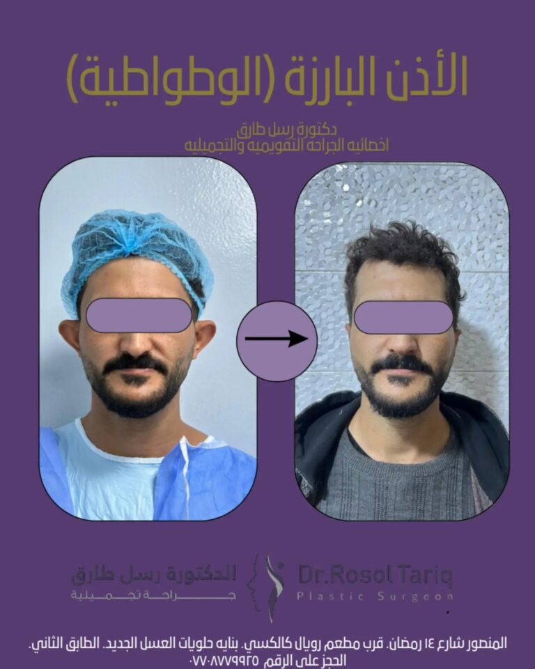 الاذن البارزه 768x960