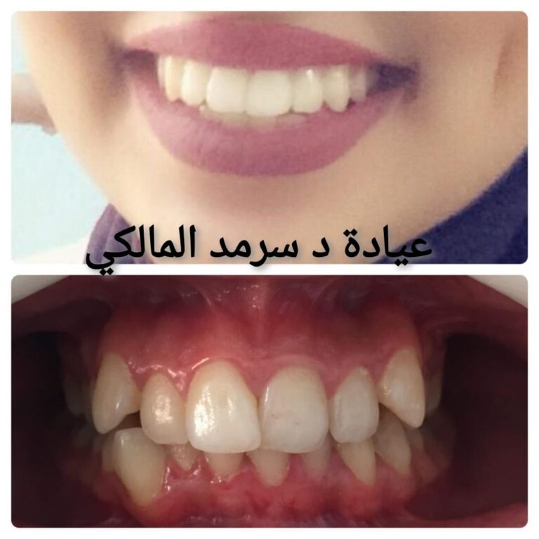 الاسنان تقويم 768x768