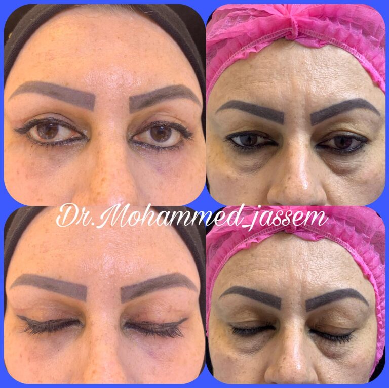 الاكياس الدهنيه 768x767