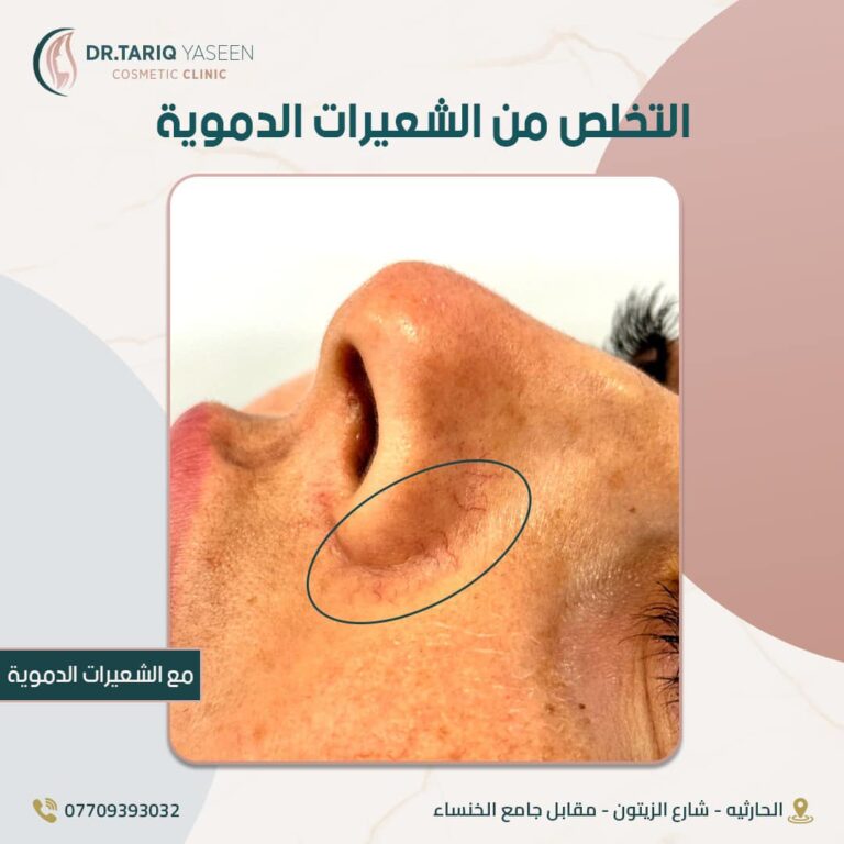 التخلص من الشعيرات الدمويه 768x768