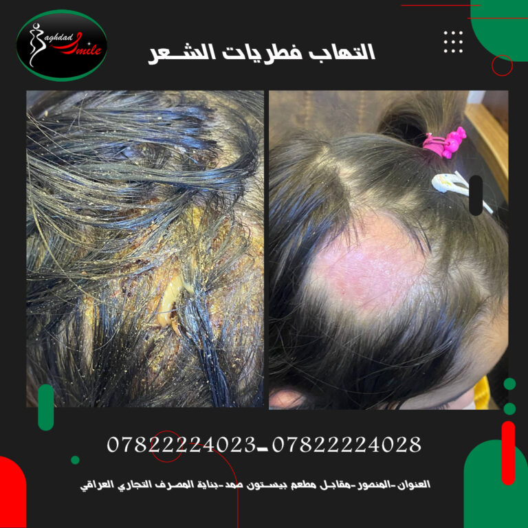 التهاب الشعر 768x768