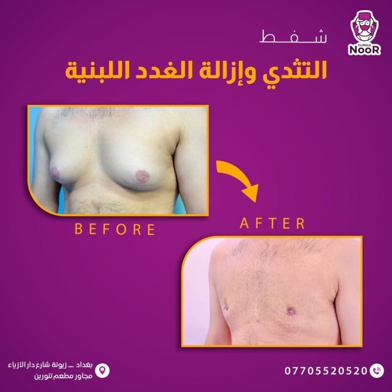 الغدة اللبنيه 768x768