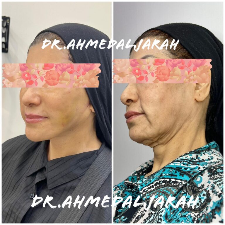 بعد اسبوعين 768x768