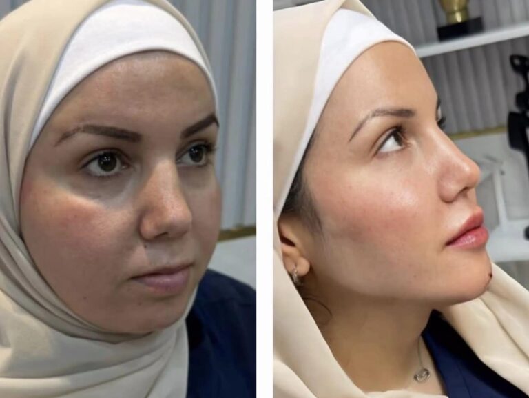 بلازمه ماتركس 768x577