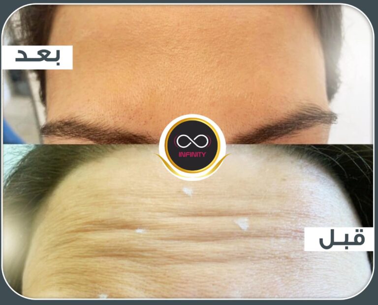 بوتكس تجاعيد 768x621