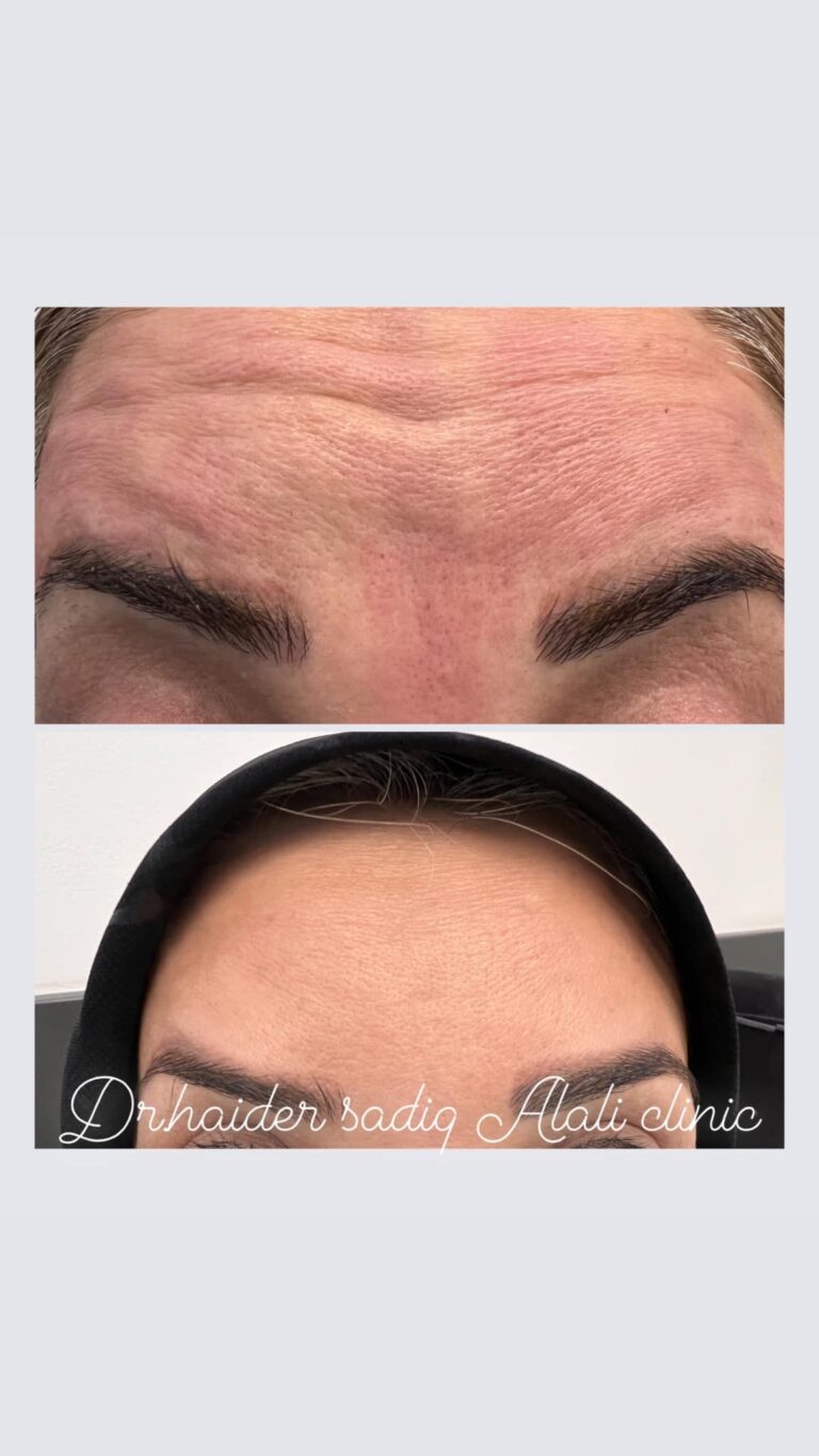 بوتوكس 768x1365