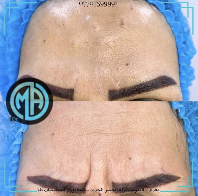 بوتوكس تجاعيد 1 768x760