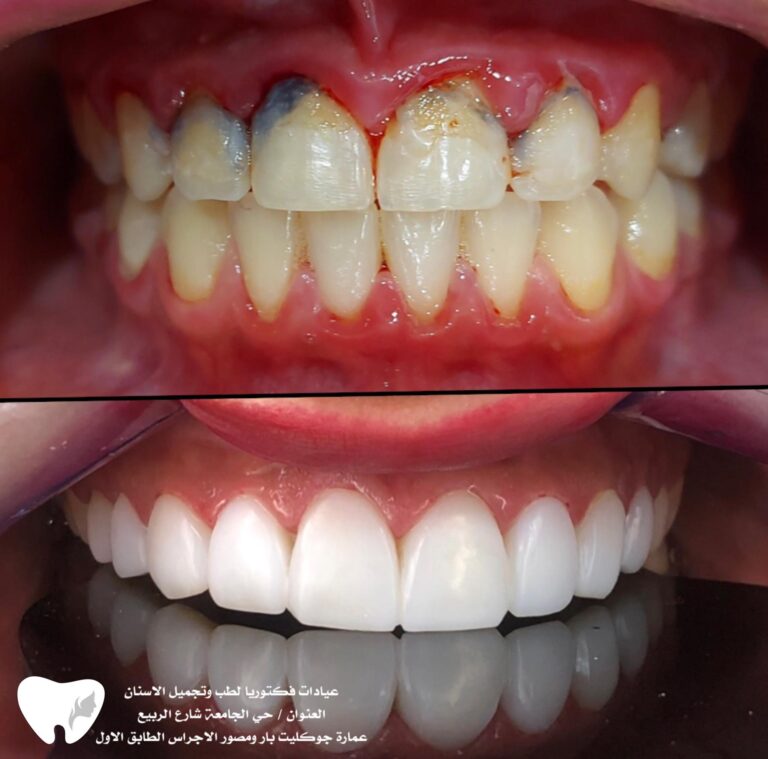 تبيض الاسنان 1 768x759