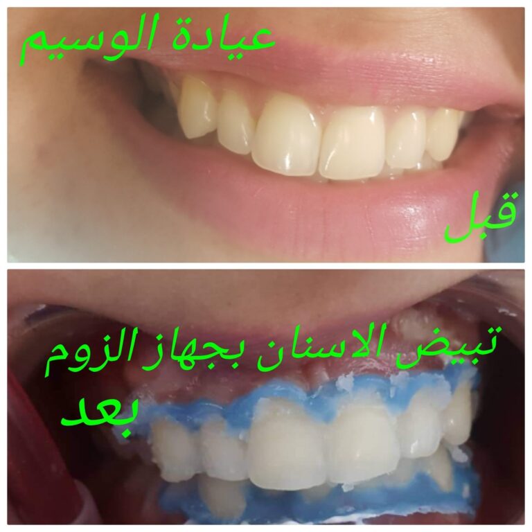 تبيض الاسنان جهاز الزوم 768x768