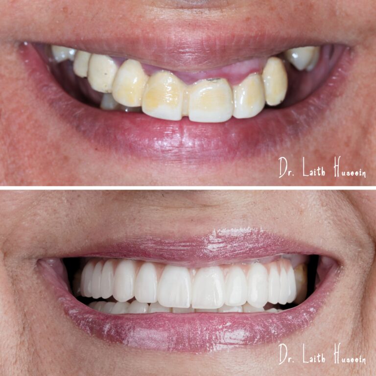 تبييض الاسنان 1 768x768
