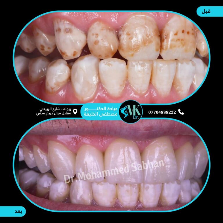تبييض الاسنان 768x768