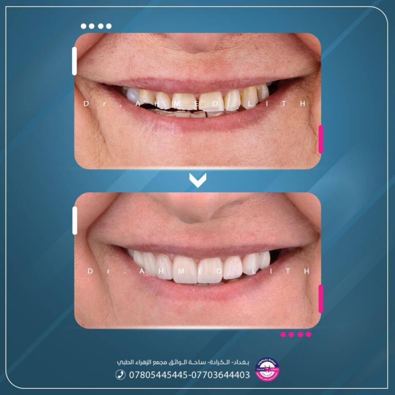 تبييض وسد فراغات اسنان 768x768