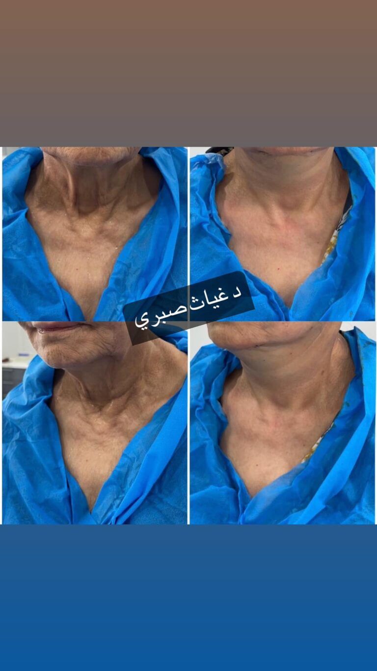 تجاعيد الرقبه 768x1365