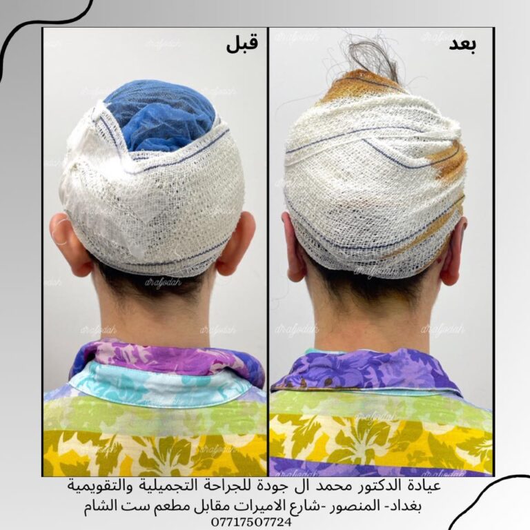 تجميل الاذن 1 768x768