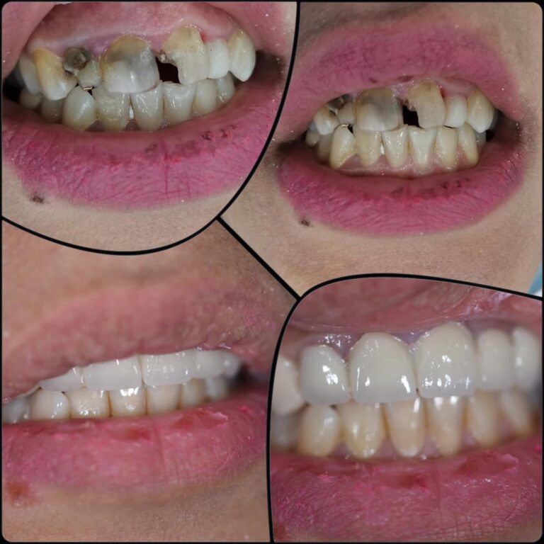 تجميل الاسنان الاماميه 768x768