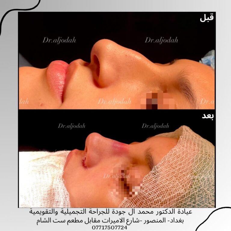 تجميل الانف 1 768x768