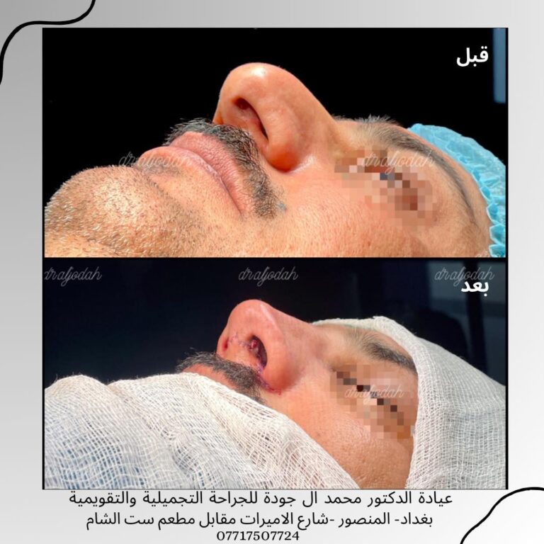 تجميل الانف 2 768x768