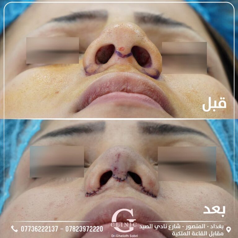 تجميل الانف 4 768x768