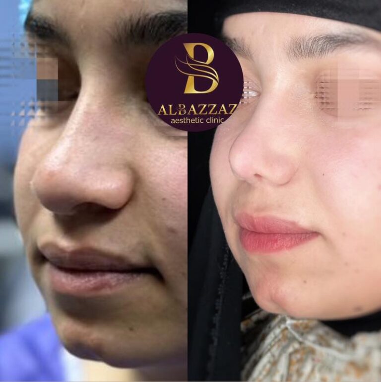 تجميل الانف 6 768x769