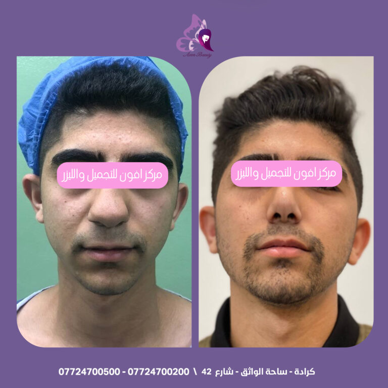 تجميل الانف 7 768x768